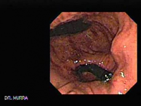 Górny odcinek przewodu pokarmowego - endoskopia - sekwencja wideo (6 z 6)