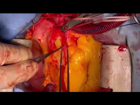Leczenie rozległego rozwarstwienia aorty wstępującej z tętniakiem prawej tętnicy wieńcowej