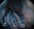 Nietypowy obraz polipów dna i trzonu żołądka w endoskopii. Chromoendoskopia. NET (5/6)