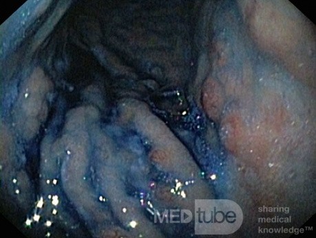 Nietypowy obraz polipów dna i trzonu żołądka w endoskopii. Chromoendoskopia. NET (5/6)