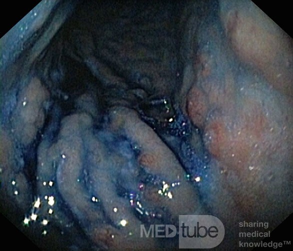 Nietypowy obraz polipów dna i trzonu żołądka w endoskopii. Chromoendoskopia. NET (5/6)