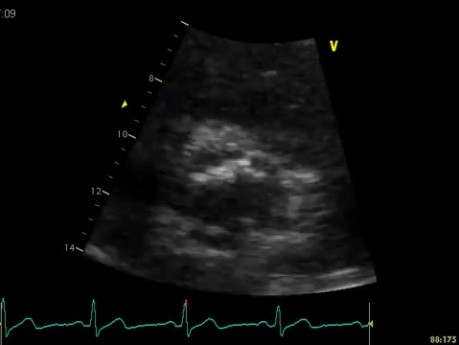 Zwapnienie tętnicy wieńcowej - płatek zastawki aortalnej a prawa tętnica wieńcowa