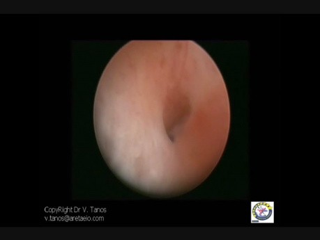 Polipowate endometrium z cechami proliferacji