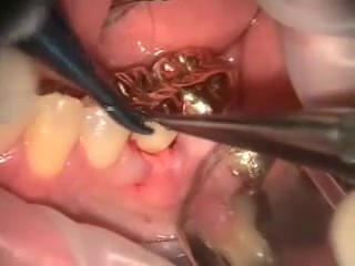 Funkcjonalny przeszczep dziąsła po stronie policzkowej zęba 36