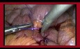 Technika zakładania szwów metodą laparoskopową