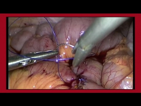 Technika zakładania szwów metodą laparoskopową