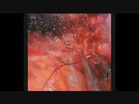 Wideotorakoskopowa skomplikowana rekonstrukcja oskrzela po bilobektomii