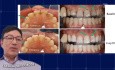 Omówienie przypadków klinicznych dotyczących wybielania zębów z dr Wymanem Chanem (MAGIC Część 2)