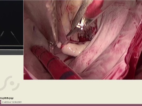 Endoskopowa kardiochirurgia - operacja na żywym sercu