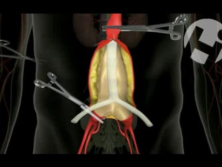 Chirurgiczne leczenie tętniaka aorty - 2