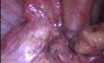 Obustronna tubektomia, adhezjoliza