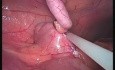 Appendektomia - Metoda SILS