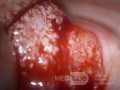Rak gruczołowy szyjki macicy (Carcinoma Glandulare Colli Uteri)