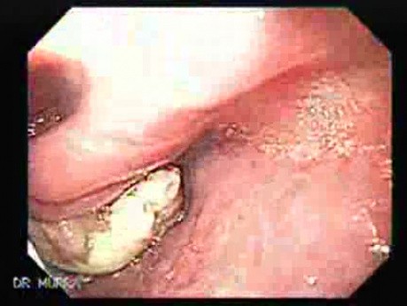 Rak płaskonabłonkowy górnej części przełyku atakuje podgłośnię - pobranie wycinków