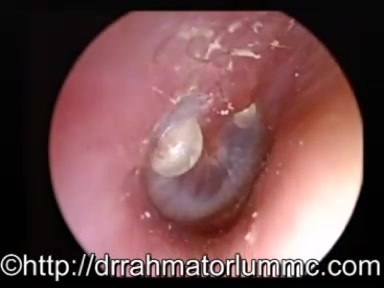Wirusowe zapalenie ucha środkowego z pojawieniem się surowiczych pęcherzyków