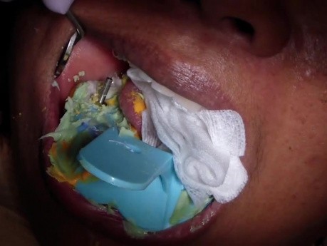 Implanty stomatologiczne - wycisk na łyżce otwartej - usunięcie z jamy ustnej