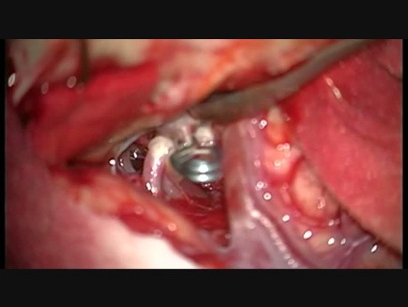 Zastosowanie wideoangiografii indocjaninowej w mikrochirurgii olbrzymich tętniaków mózgowych