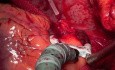 Pomostowanie tętnic wieńcowych bez użycia krążenia pozaustrojowego - 48-letni pacjent
