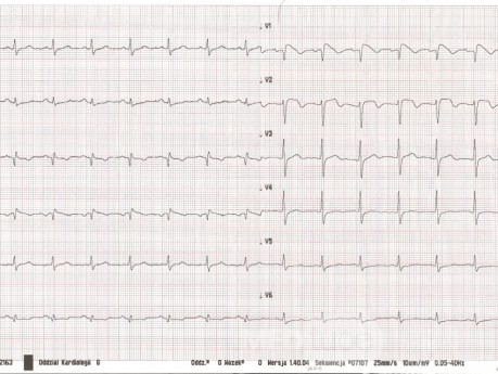 EKG - zespół Brugadów