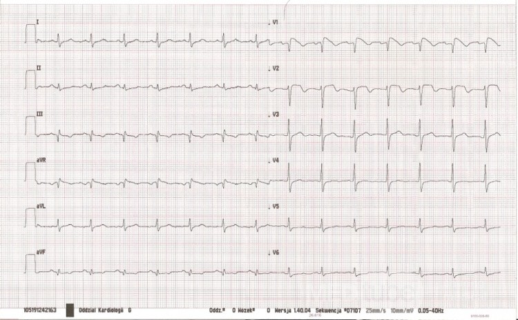 EKG - zespół Brugadów