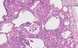 Sarkoidoza - histopatologia - płuco