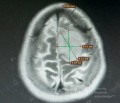 Planowanie operacji z użyciem Neuronavigatora u pacjenta z masą wewnątrzczaszkową. Glejak wysokiego stopnia.