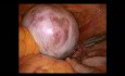 Potworniak jajnika- usunięcie jajnika