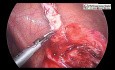 Laparoskopia - perforacja wyrostka robaczkowego w położeniu zakątniczym