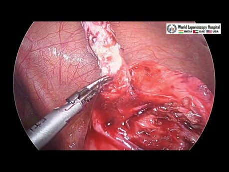 Laparoskopia - perforacja wyrostka robaczkowego w położeniu zakątniczym