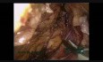 Laparoskopowa resekcja raka zgięcia wątrobowego okrężnicy