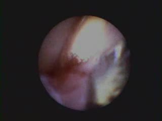 Arestin - antybiotykoterapia chorób przyzębia