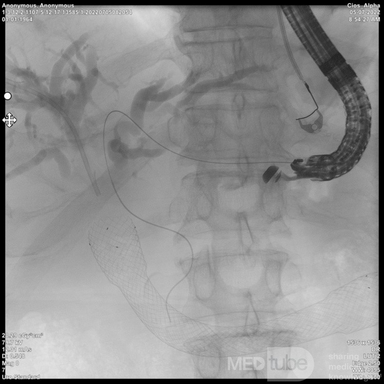 Endoskopowa hepaticogastrostomia pod kontrolą EUS [3/10]