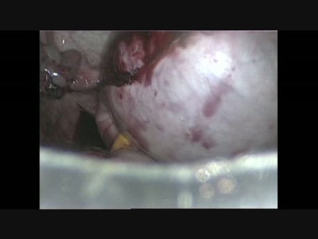 Laparoskopowa resekcja cysty jajnika