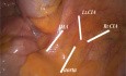 Podejście laparoskopowe do operacji raka odbytnicy
