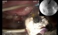 Leczenie endoskopowe następstw ostrego martwiczego zapalenia trzustki