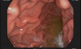 Żołądek w klatce piersiowej - czy endoskopista może "zgubić się" podczas gastroskopii? 