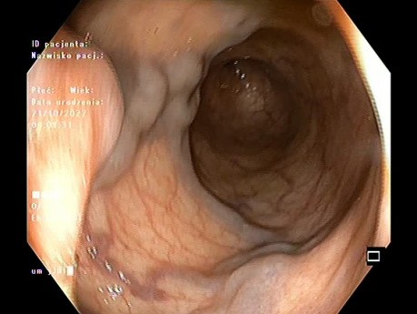 Żylaki odbytnicy/ Rectal varices