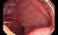 Możliwości zabiegowe w zakresie endoskopii przewodu pokarmowego (pEMR From Behind a Corner)