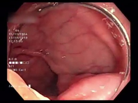 Możliwości zabiegowe w zakresie endoskopii przewodu pokarmowego (pEMR From Behind a Corner)