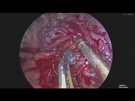Wideotorakokopowa szczytowotylna segmetektomia z uwidocznieniem anomalii anatomicznej tętnic A1+A3