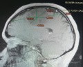 Planowanie operacji z użyciem Neuronavigatora u pacjenta z masą wewnątrzczaszkową. Glejak wysokiego stopnia.