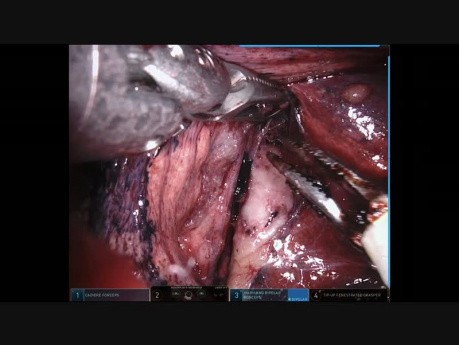 Resekcja anatomiczna segmentu płuca w asyście robota