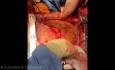 Lung Transplantation - Part 1 - Procurement 