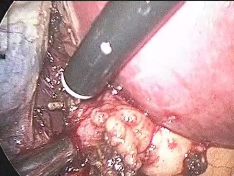 Podczas laparoskopowej cholecystektomii powinieneś mieć przynajmniej jeden port 10 mm