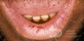 Usta w chorobie Rendu-Oslera-Webera