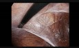 Laparoskopowa plastyka przepukliny pachwinowej- krok 3: lewostronne nacięcie otrzewnej