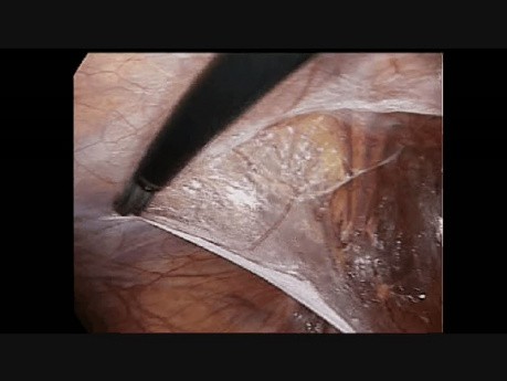 Laparoskopowa plastyka przepukliny pachwinowej- krok 3: lewostronne nacięcie otrzewnej