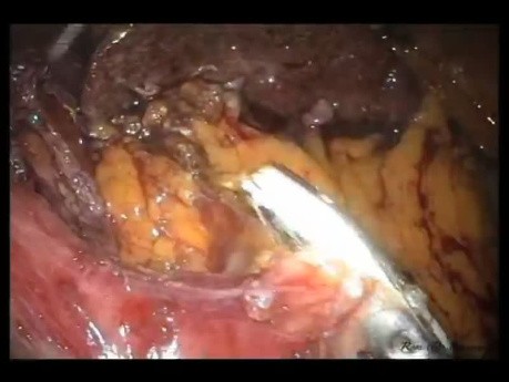 Laparo-endoskopowa jednomiejscowa (LESS) operacja przepukliny Morgagniego oraz  fundoplikacja sposobem Toupeta