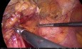 Usunięcie śledziony techniką laparoskopową