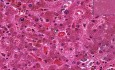 Wątroba - hemochromatoza